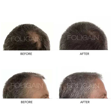 Discovering Effective Minoxidil Alternatives for Hair Growth